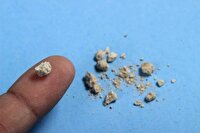 ابتلای کودکان به سنگ کلیه با مصرف آنتی‌بیوتیک، چیپس، سوسیس و کالباس